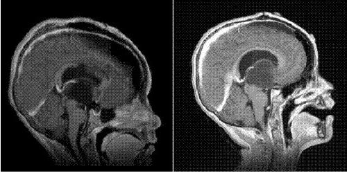 脳の星細胞腫とは何ですか？脳の星状細胞腫：予後