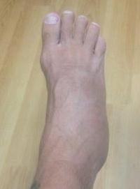 足の症状の骨折