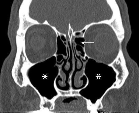 鼻の副鼻腔のMRI：何を表示するのか？鼻洞の断層撮影